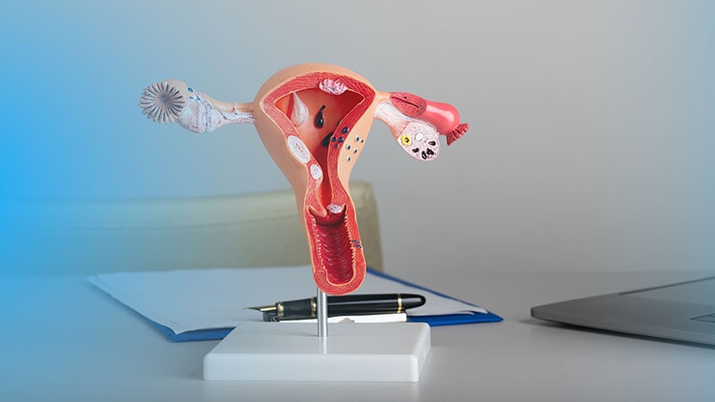 Endometrioza – czym jest i jak ją leczyć?